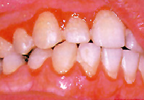 Inflamed gums